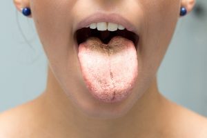 Candida: cos&rsquo;&egrave;, tipologie, cause, sintomi, cure e prevenzione