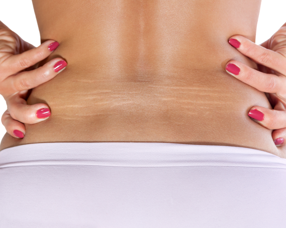 La bava di lumaca è sempre più ambita in cosmesi: ecco perché 1 bava di lumaca: creme per prevenire le smagliature