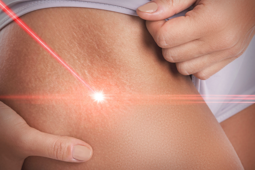 Smagliature: cosa sono, cause, rimedi e trattamenti a casa e dal dermatologo, dieta e prevenzione 21 smagliature: trattamenti efficaci e costi