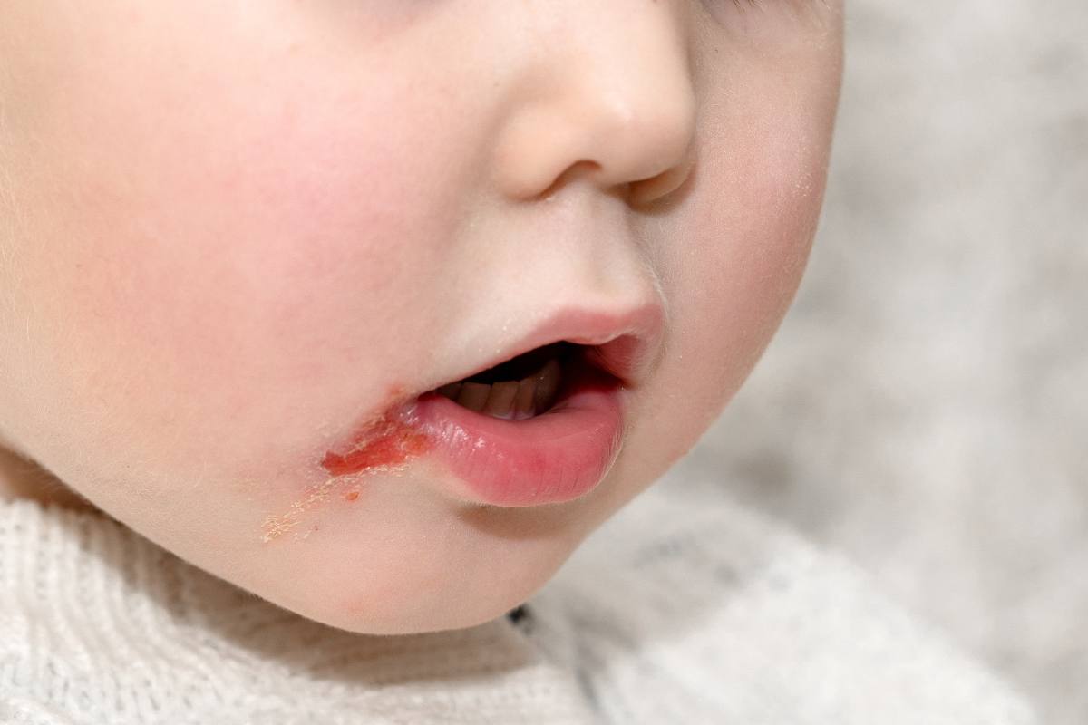 Herpes labiale: sintomi, diagnosi e cura 3 Herpes labiale nei bambini