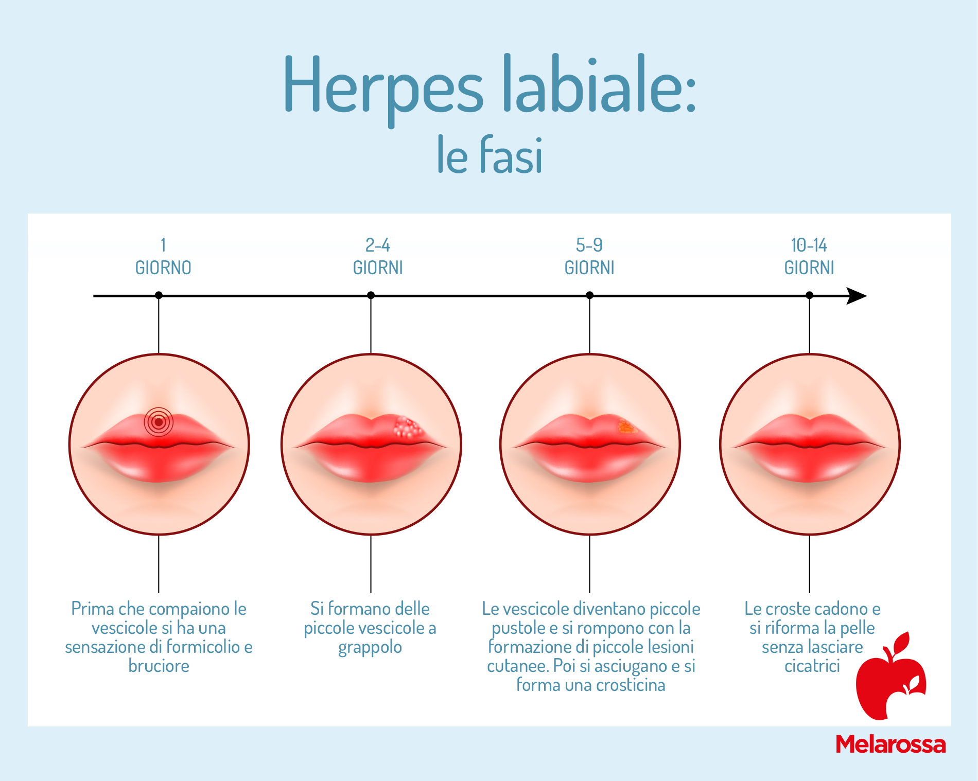 Herpes labiale: sintomi, diagnosi e cura 2 Le fasi dell'herpes labiale