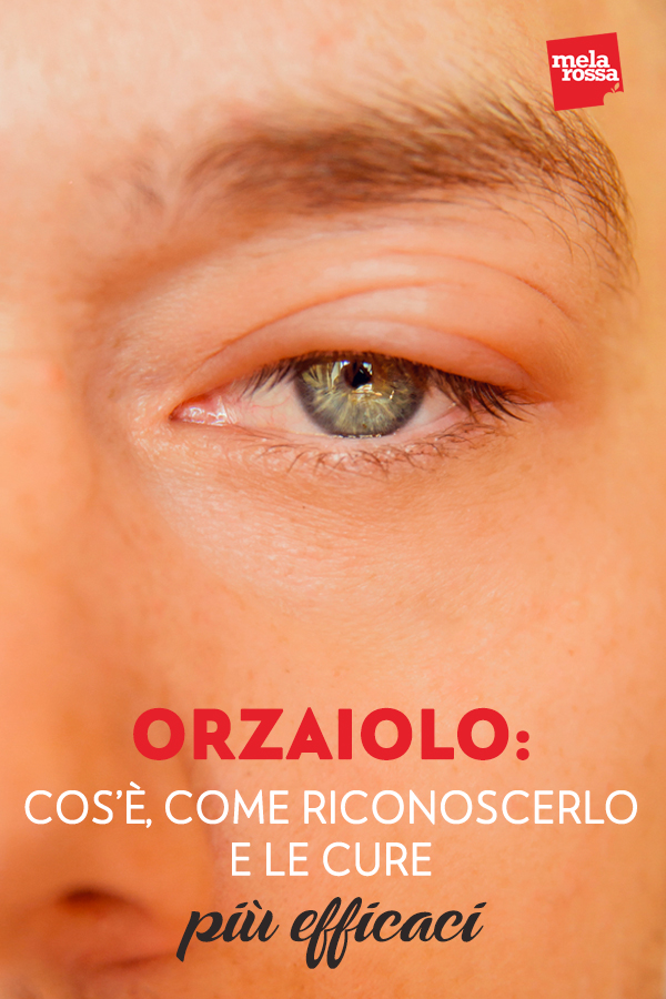 Orzaiolo: cos'è, come riconoscerlo e le cure più efficaci 6 Dolore agli occhi, arrossamento e un antiestetico rigonfiamento della palpebra: è l’orzaiolo, un’infezione che colpisce la palpebra ma che, se curata seguendo i consigli del medico, passa nel giro di pochi giorni. Bisogna avere pazienza ed evitare cure “fai da te” che potrebbero rendere pericolosa una patologia banale. Ma cos’è esattamente l’orzaiolo? Che differenza c’è con il calazio? Come si riconosce e come si cura? Melarossa.it #dietamelarossa