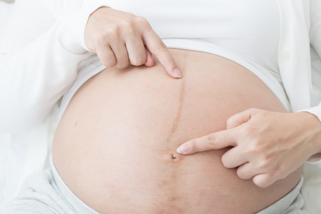 Modifiche del corpo materno 4 modifiche del corpo materno: la pelle