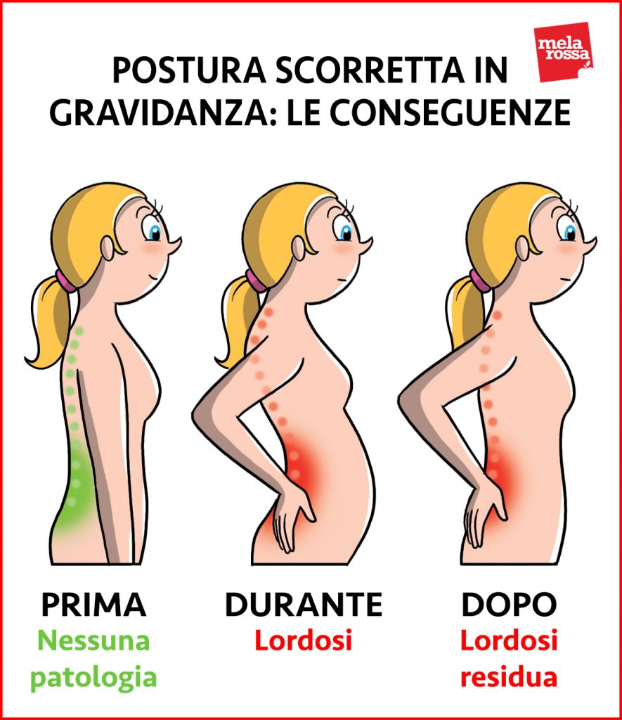 Modifiche del corpo materno 3 modifiche del corpo materno: postura e mal di schiena