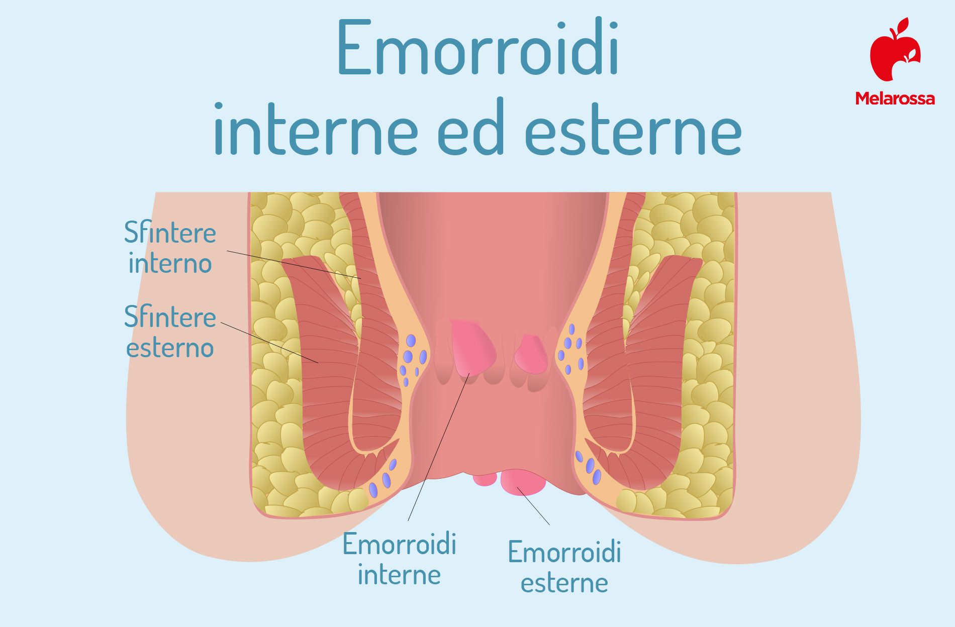 Emorroidi: cause e sintomi, cosa mangiare, cure e rimedi 1 emorroidi interne ed esterne