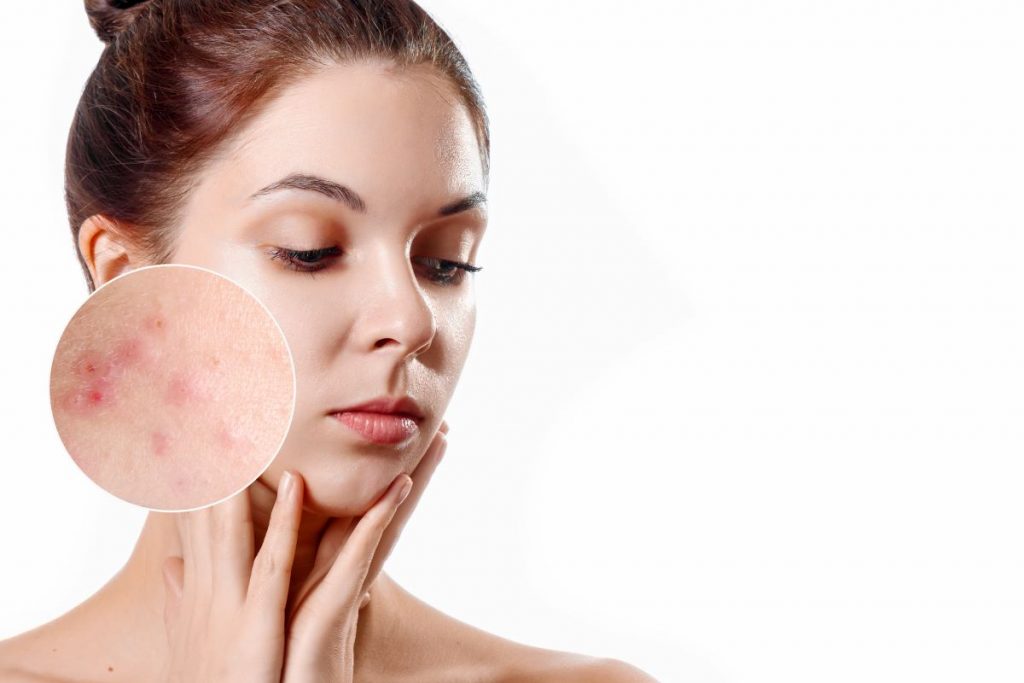 Dormire truccate: ecco cosa rischi se dimentichi di rimuovere il make up dal tuo viso 1 acne-viso