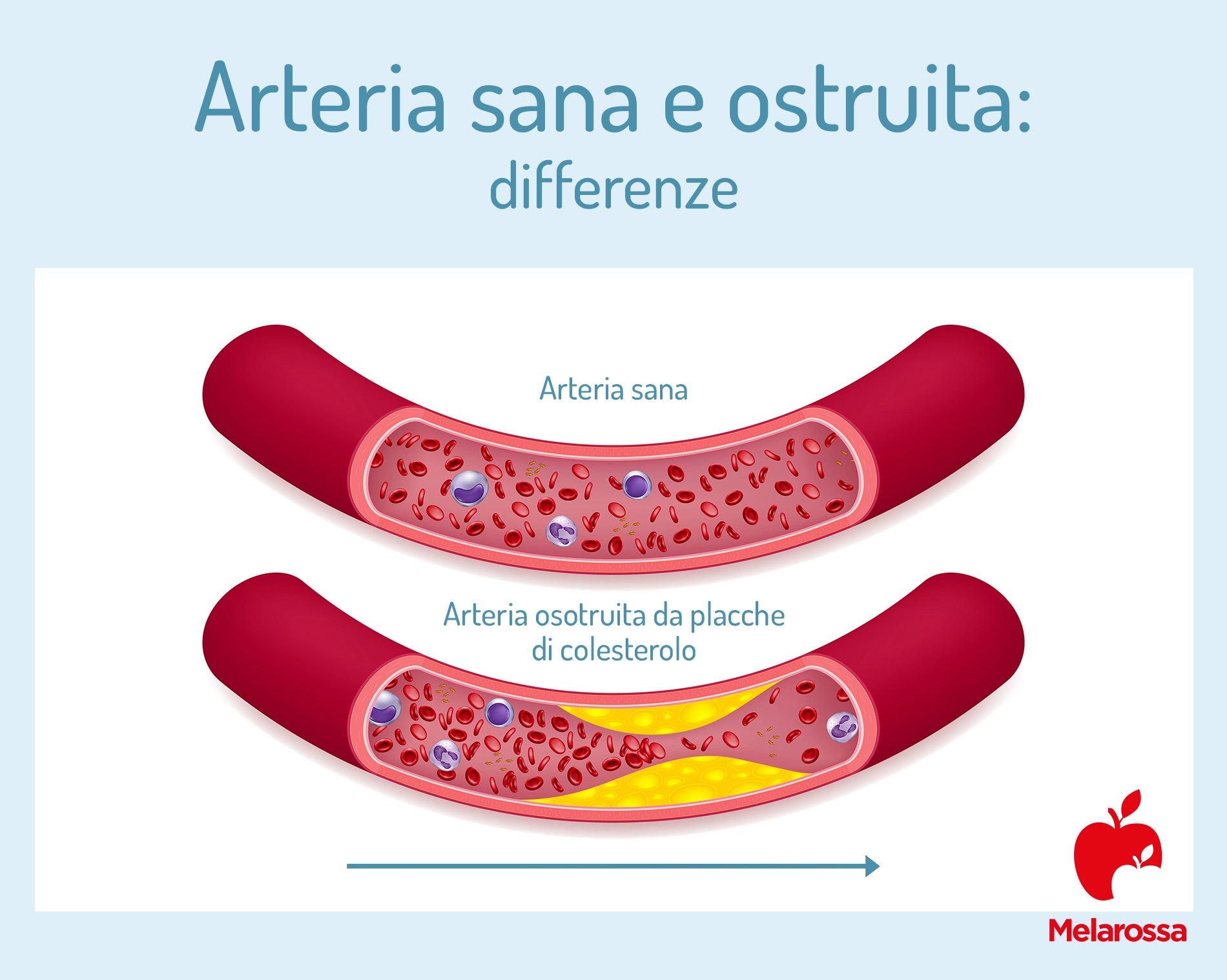 Arterie: cosa sono, anatomia e funzione 3 artere sane e ostruite