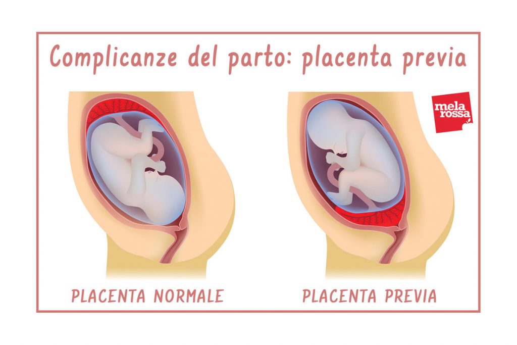 Complicanze del travaglio e del parto: quali sono e cosa fare per affrontarle 3 complicanze del parto: placenta previa