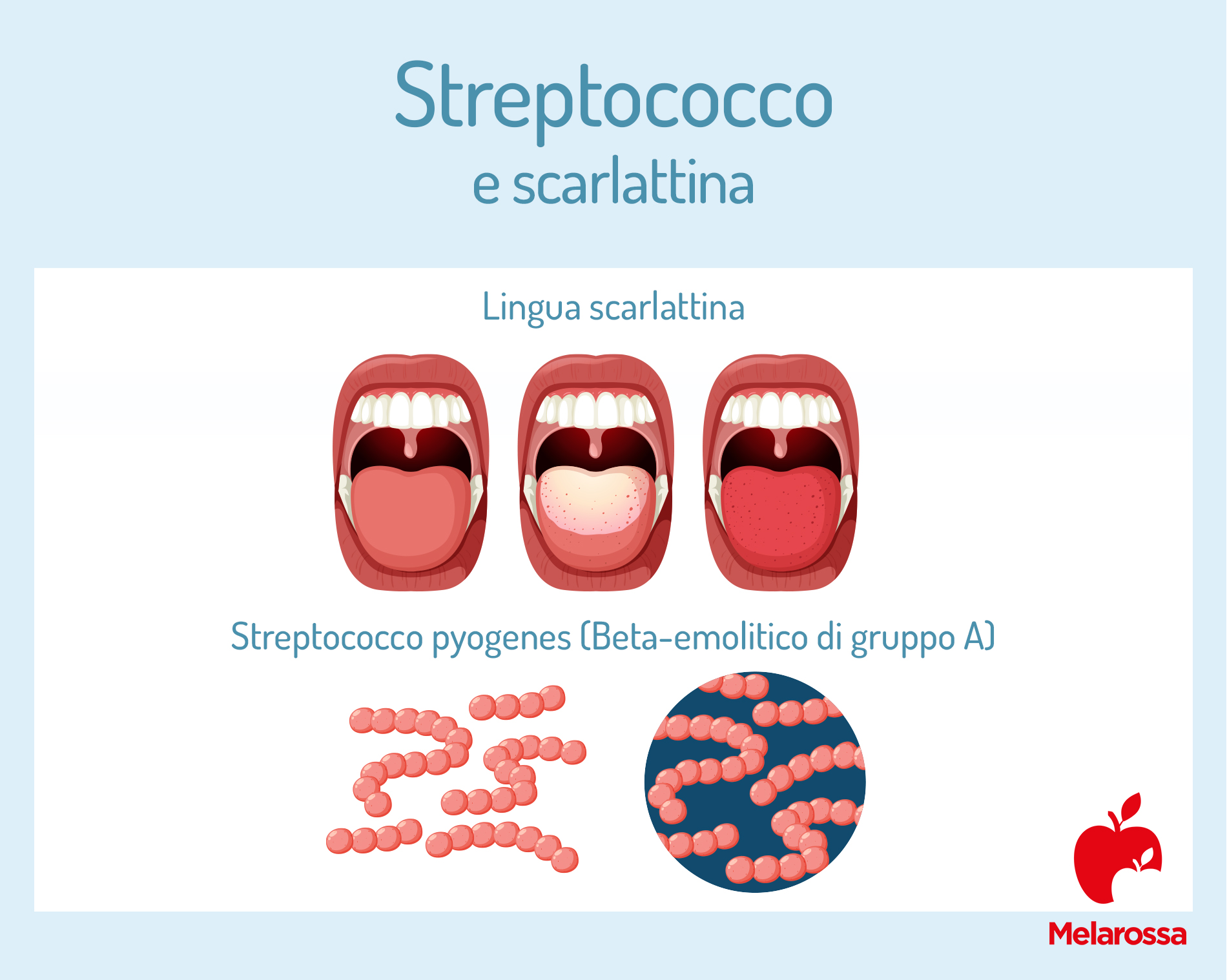 Infezioni da streptococco: cosa sono, quali sono, sintomi e come curarle 3 Streptococco e scarlattina