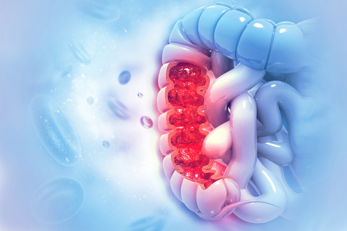 Tumore del colon, scoperte cellule dormienti che resistono alle cure: passo avanti per lo sviluppo di terapie più efficaci 1 cancro colon: scoperto meccanismo sopravvivenza cellule