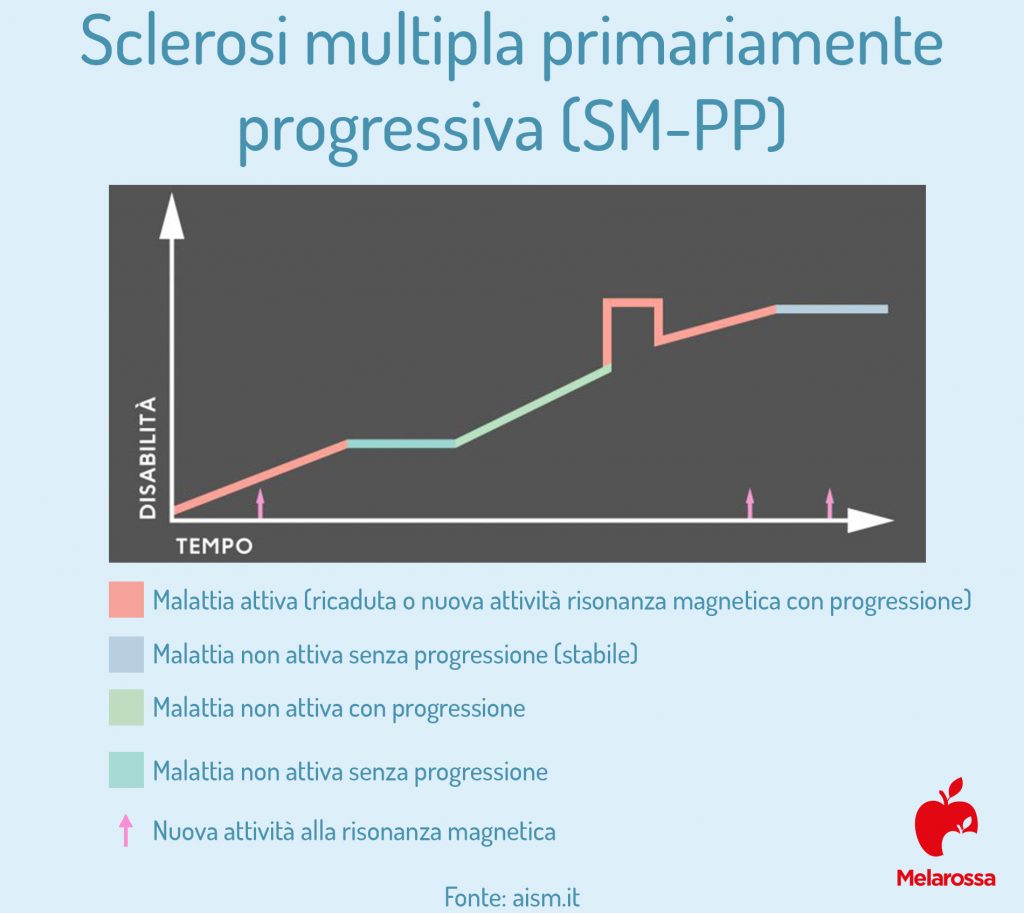 Sclerosi multipla: che cos'è, sintomi, diagnosi e cura 7 Sclerosi Multipla primariamente progressiva