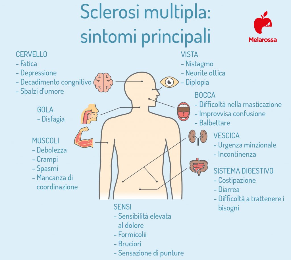 Sclerosi multipla: che cos'è, sintomi, diagnosi e cura 3 Sclerosi multipla: i sintomi