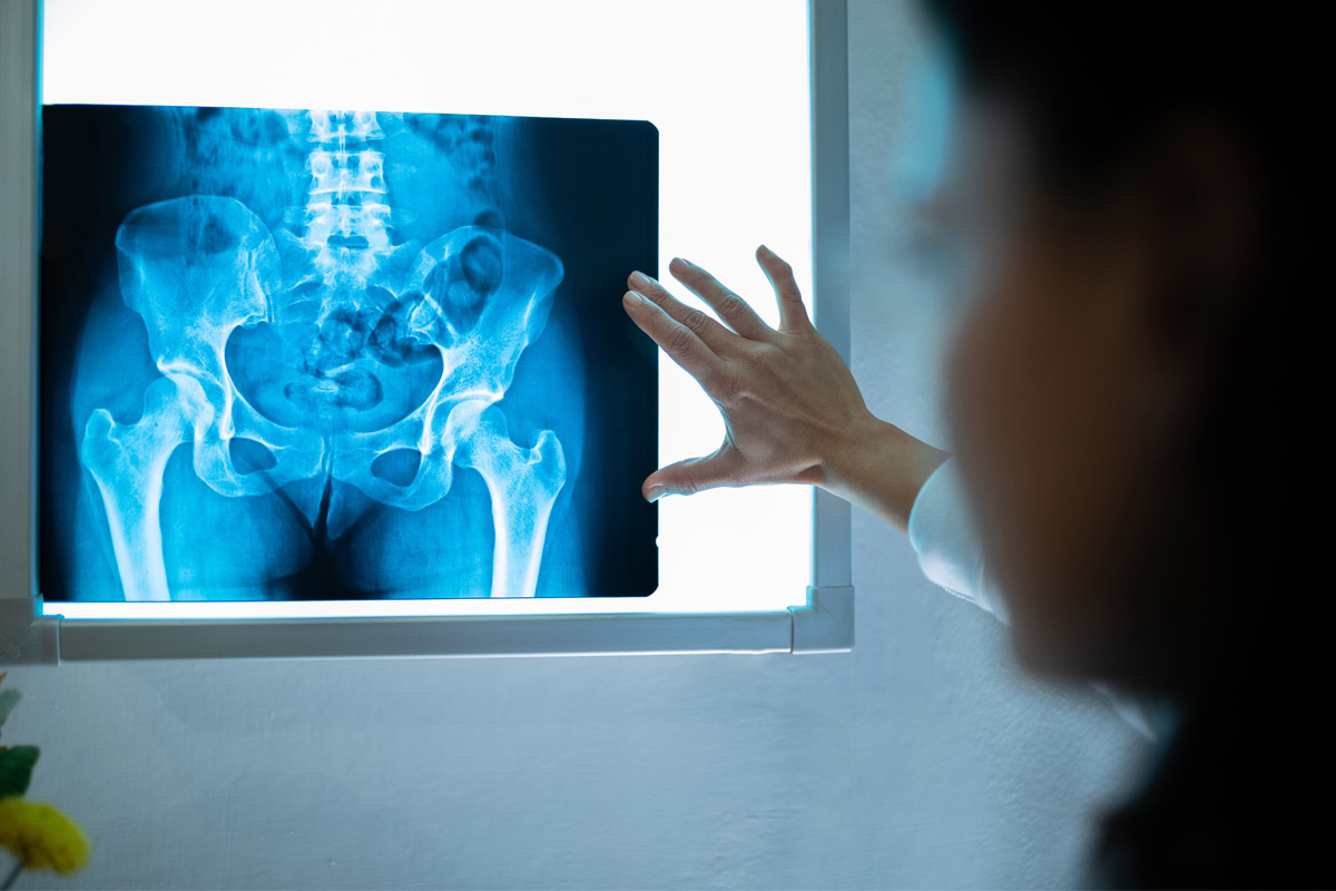 Lo smog indebolisce le ossa e aumenta il rischio di osteoporosi 1 smog indebolisce ossa