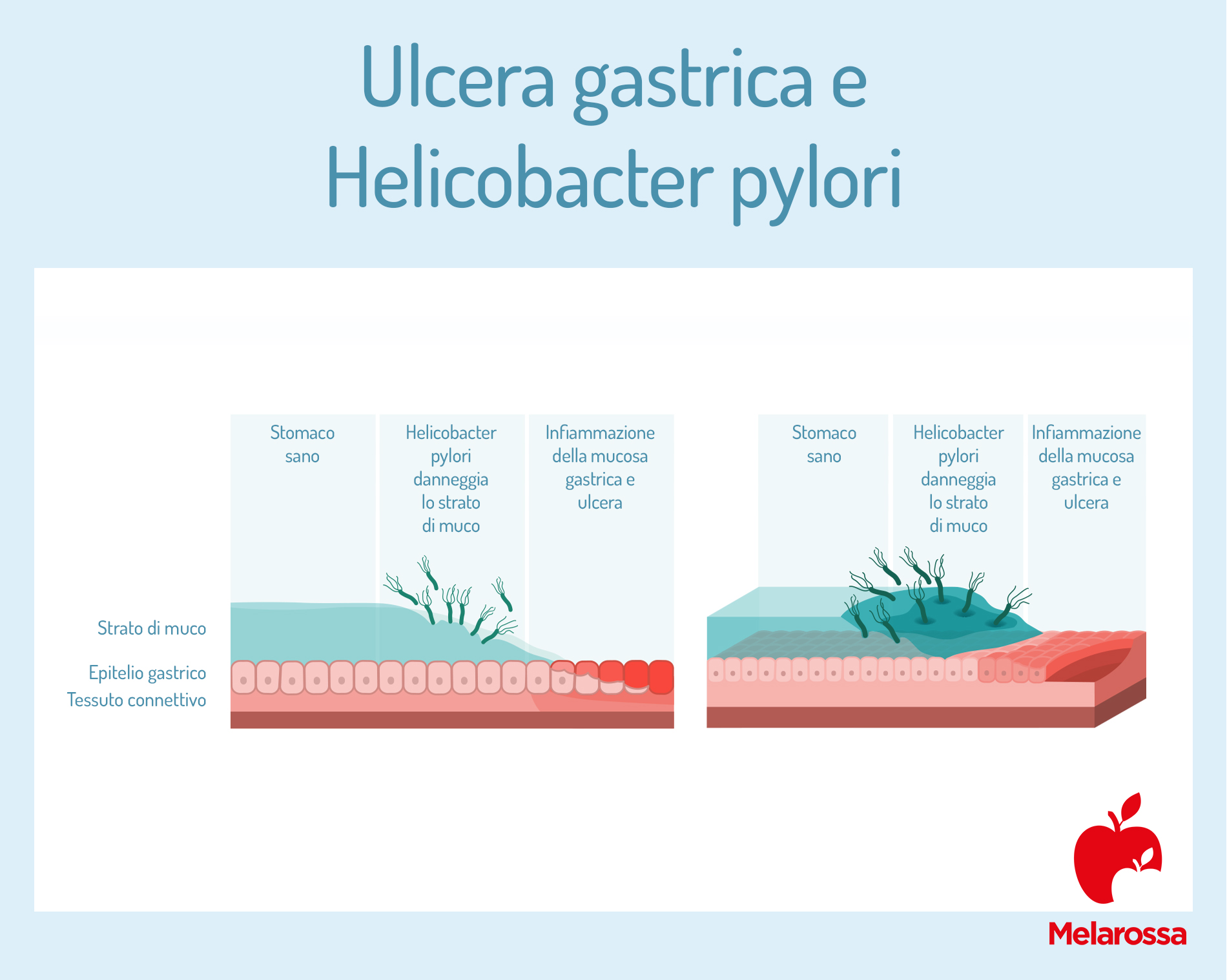 Helicobacter Pylori: cos'è, contagio, sintomi, complicanze, test e cure 3 ulcera gastrica e helicobacter pylori
