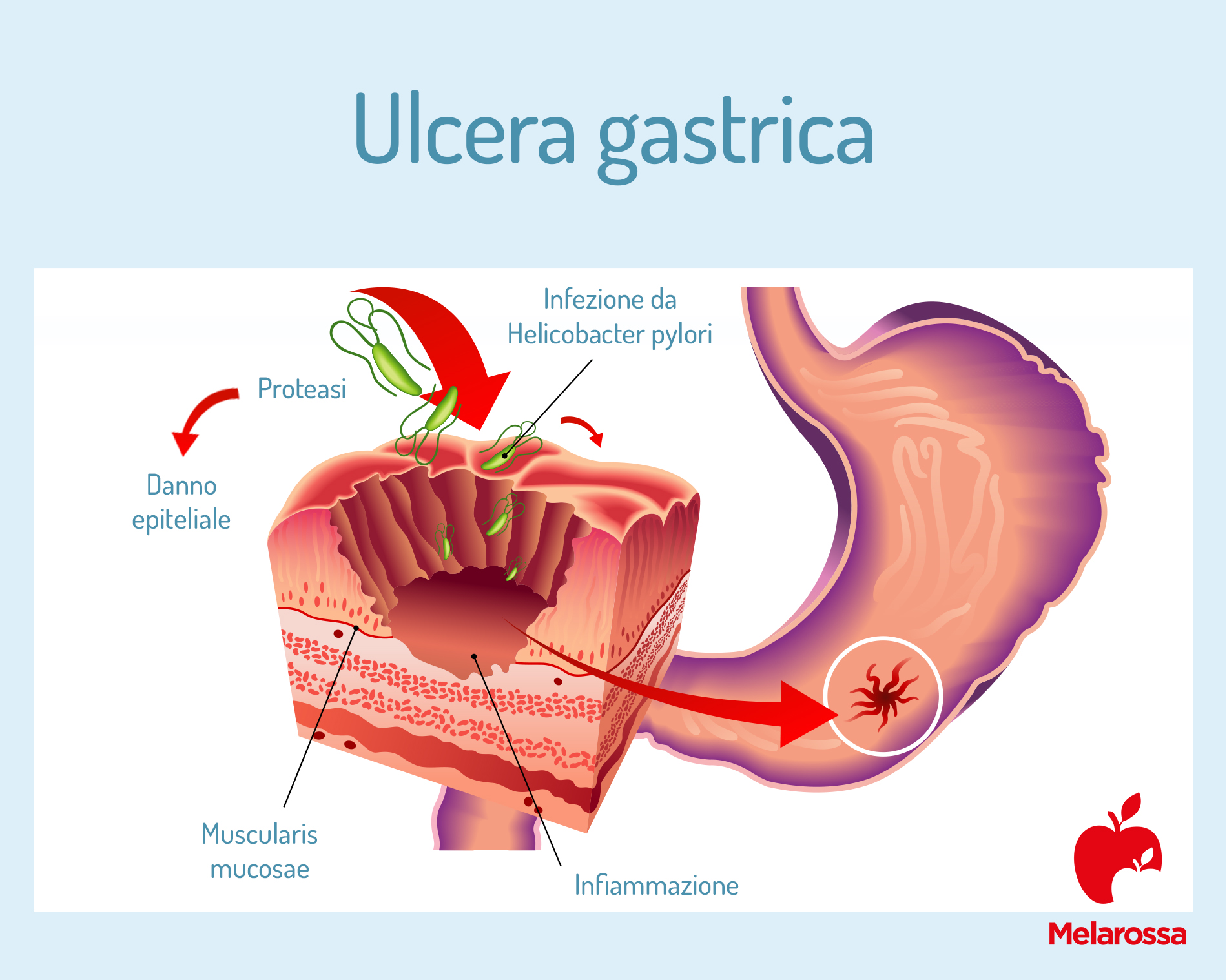 Ulcera gastrica: che cos’è, cause, sintomi, complicanze, diagnosi e cura 1 ulcera gastrica: cos'è