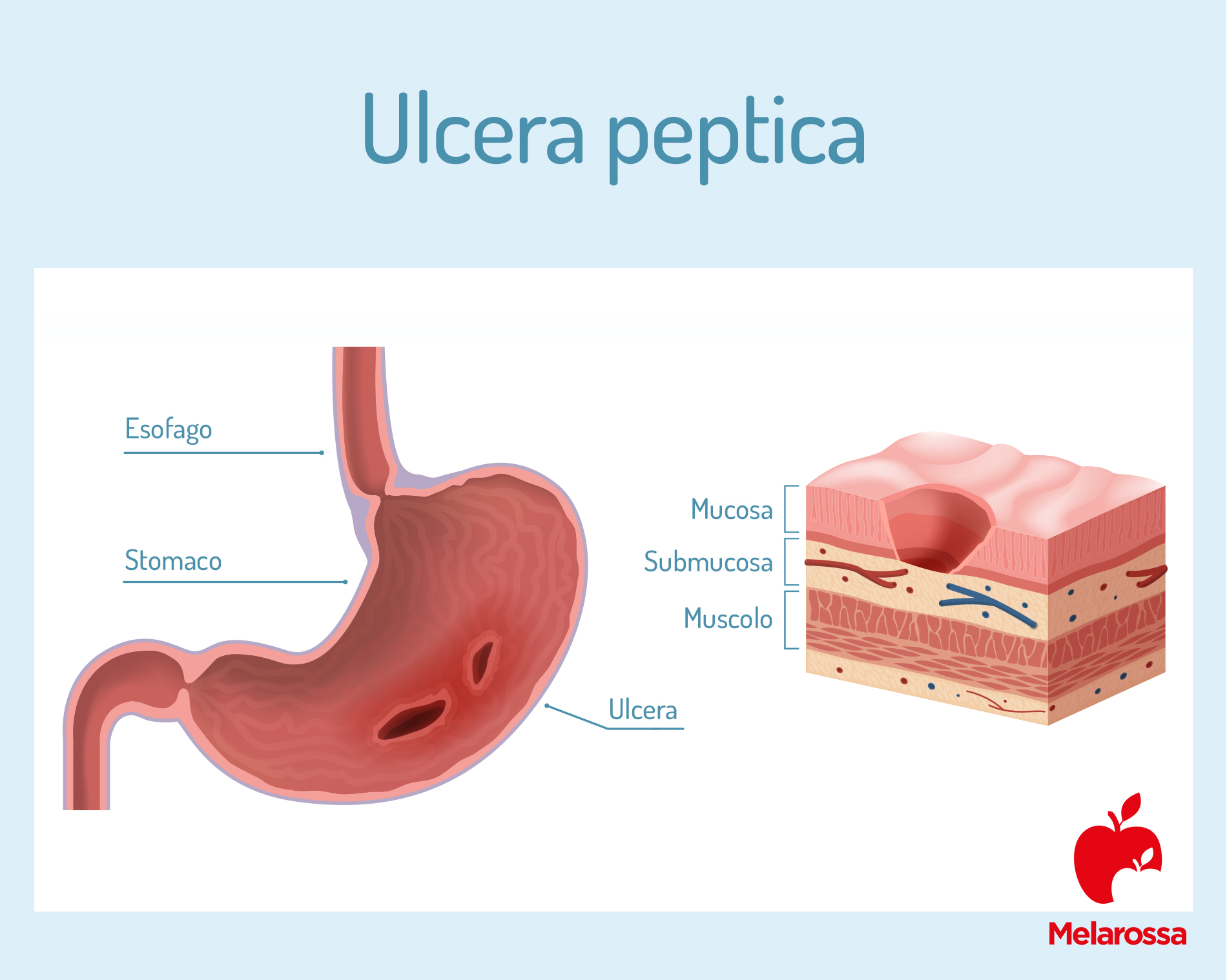 Ulcera gastrica: che cos’è, cause, sintomi, complicanze, diagnosi e cura 2 ulcera peptica: cos'è