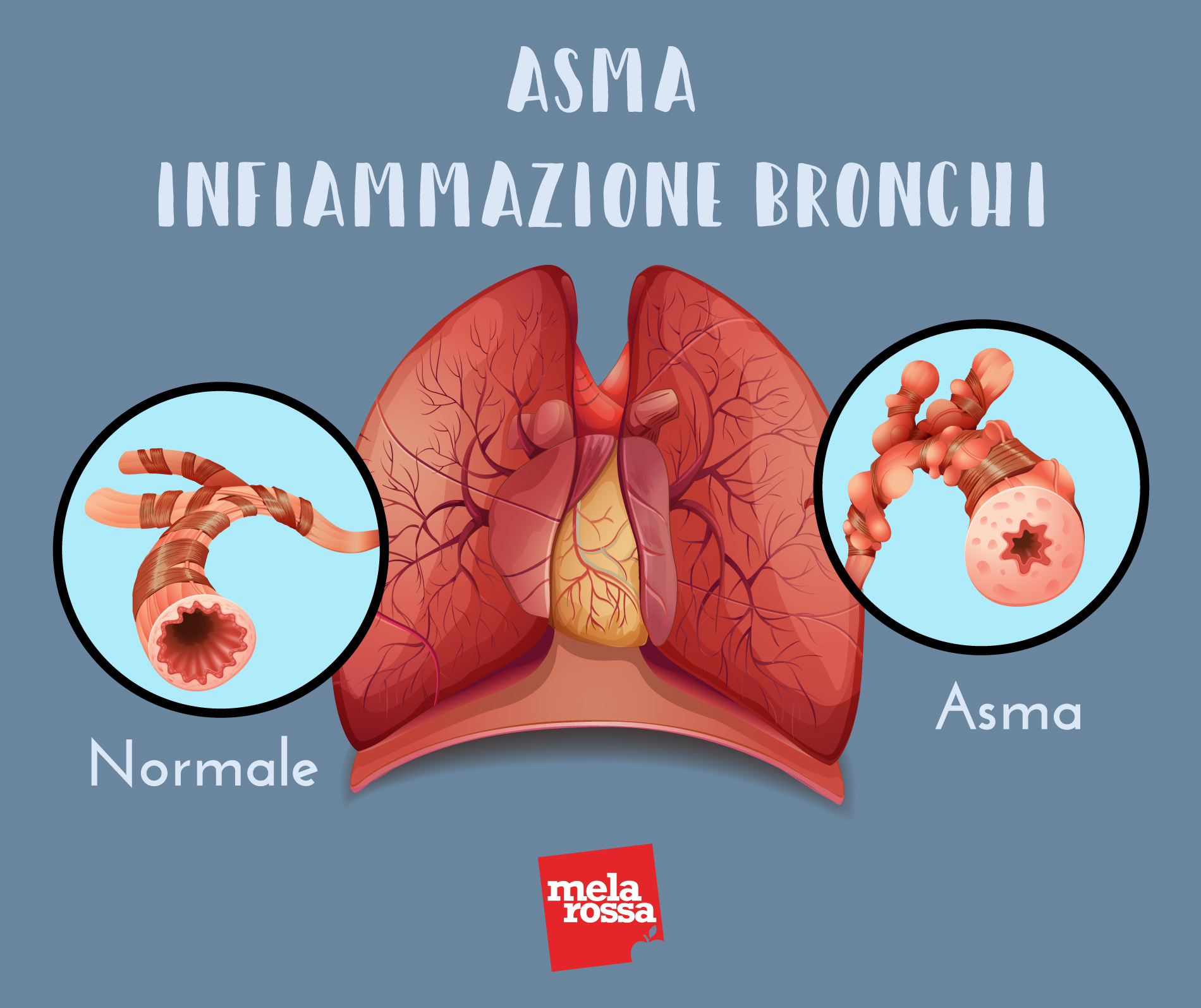 Asma: che cos'è, sintomi, cause e fattori di rischio, diagnosi, trattamenti 1 asma: infiammazione bronchi