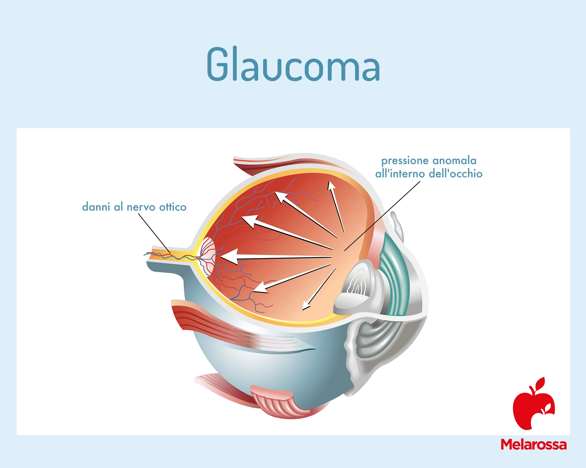 Glaucoma: sintomi, cura e prevenzione 1 Una grafica che illustra con un'immagine il glaucoma