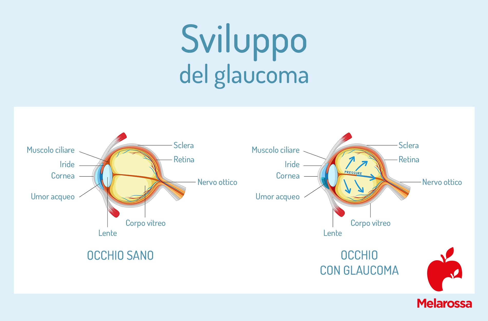 Glaucoma: sintomi, cura e prevenzione 2 Una grafica che illustra le diverse fasi del glaucoma
