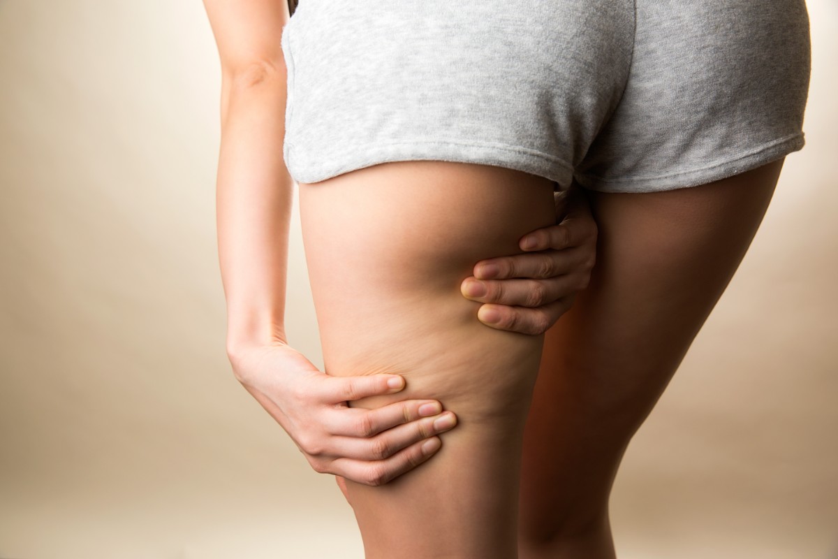 Pungitopo: proprietà, botanica, benefici, controindicazioni, modalità d'uso e ricette 4 pungitopo: efficace contro la cellulite