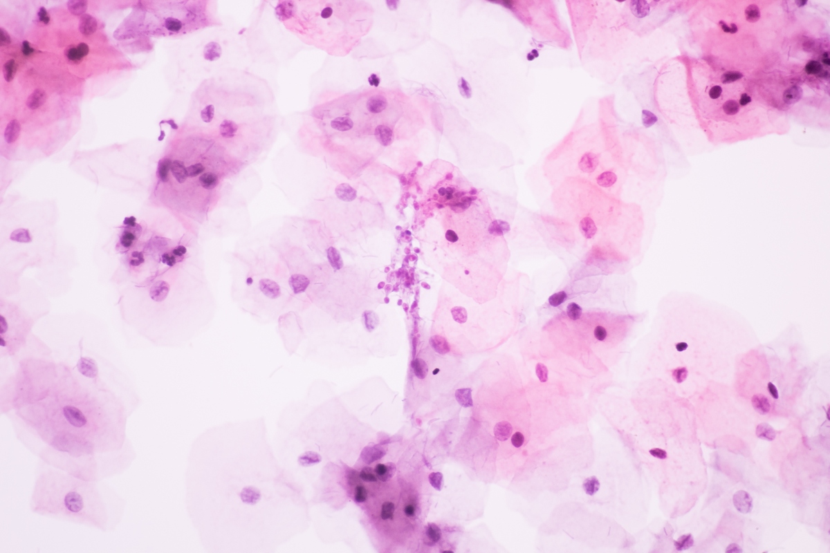 PAP test: che cos'è, a cosa serve, come si esegue e quando 3 papa tes positivo: come interpretarlo