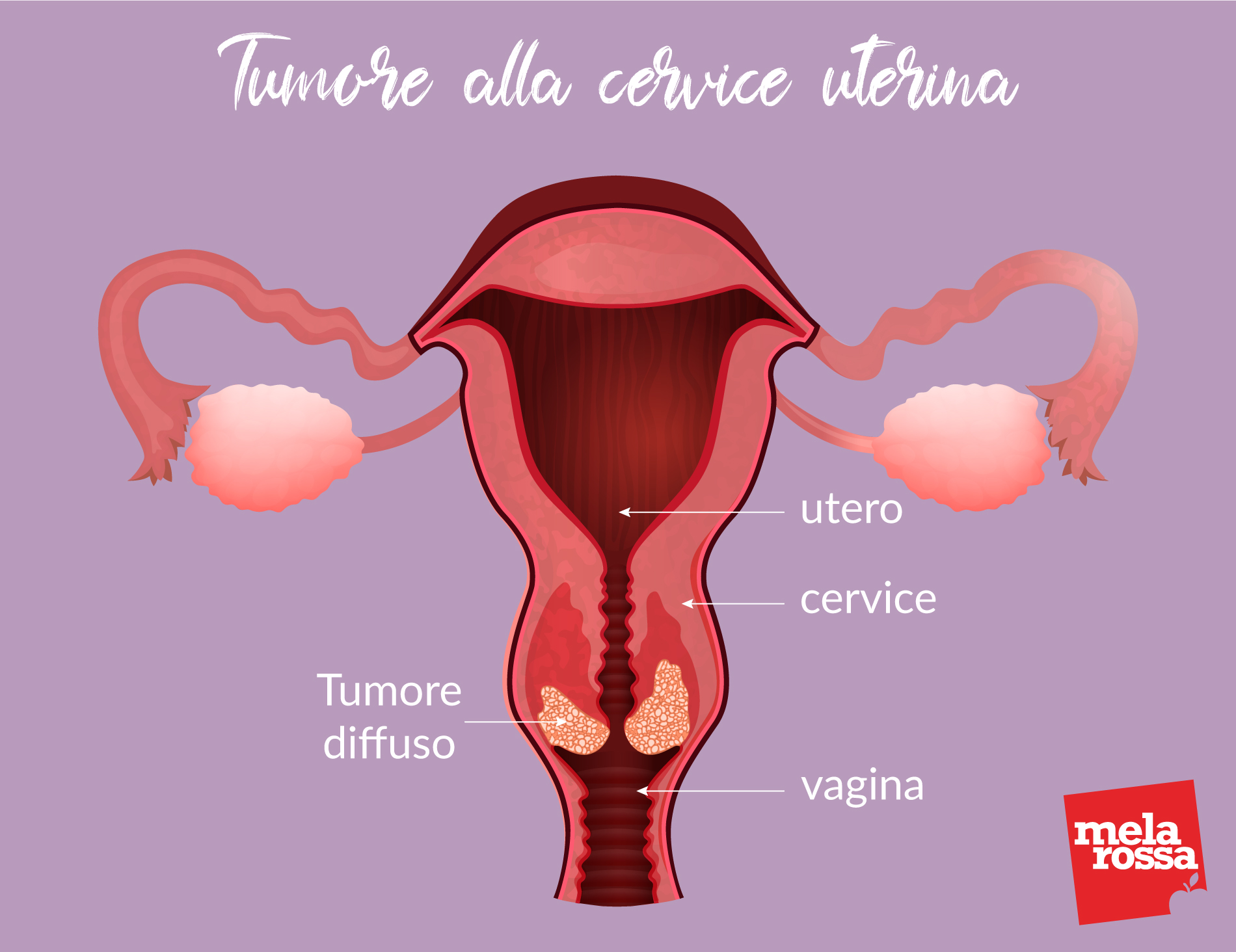 PAP test: che cos'è, a cosa serve, come si esegue e quando 1 papa test per prevenire il tumore