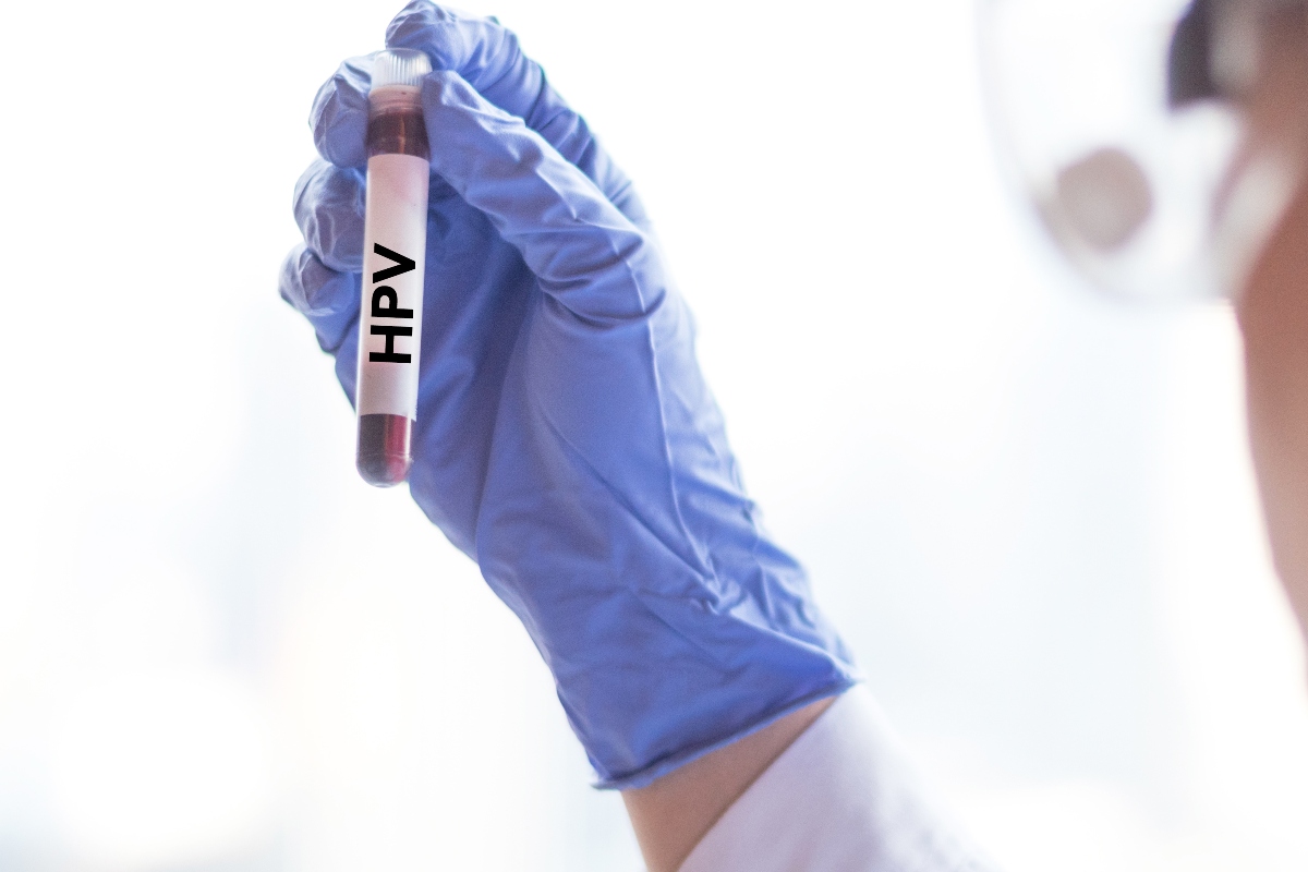 Papilloma virus umano (HPV): cos'è, infezione, contagio, sintomi, conseguenze, prevenzione con vaccino 2 papilloma virus e tumori