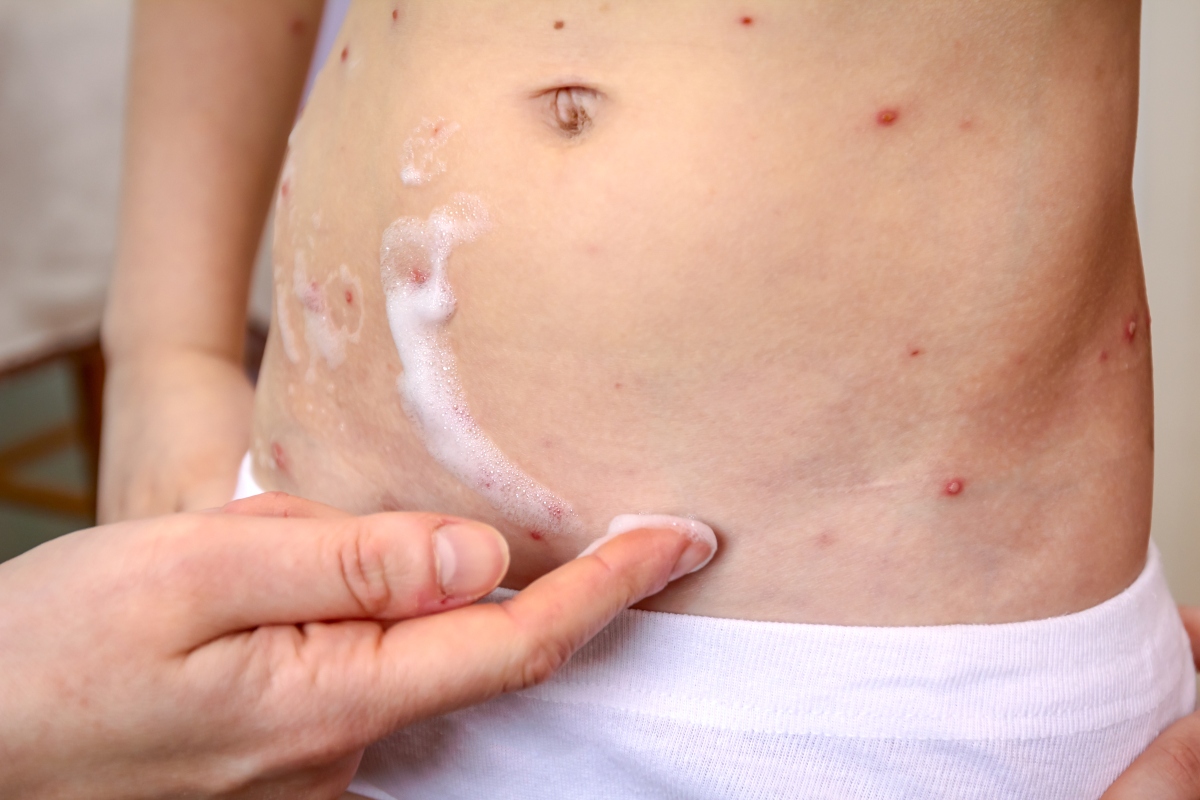 Varicella: che cos'è, contagio, sintomi, complicazioni, diagnosi, trattamenti e prevenzione 4 varicella: contagio