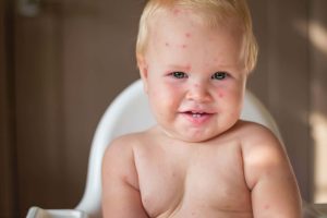 Varicella: che cos&rsquo;&egrave;, contagio, sintomi, complicazioni, diagnosi, trattamenti e prevenzione