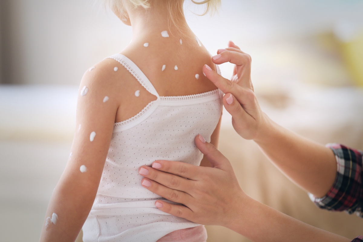 Varicella: che cos'è, contagio, sintomi, complicazioni, diagnosi, trattamenti e prevenzione 8 varicella: cura