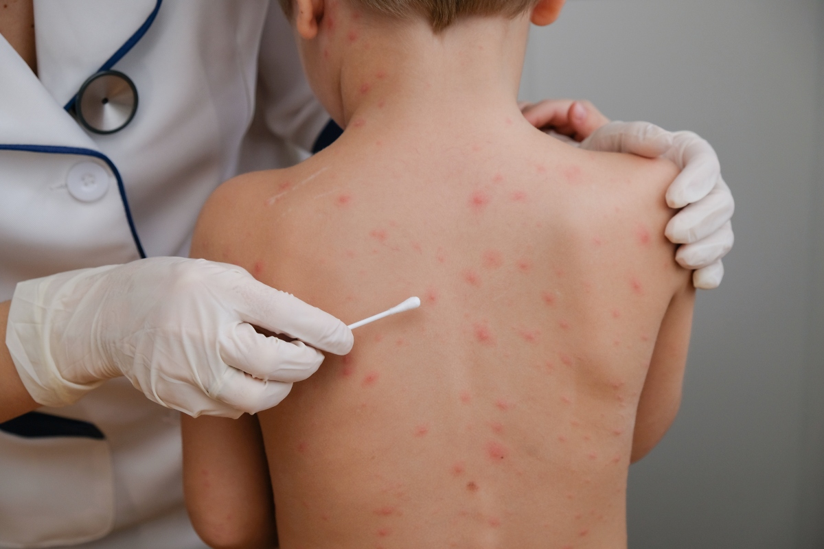 Varicella: che cos'è, contagio, sintomi, complicazioni, diagnosi, trattamenti e prevenzione 7 varicella: diagnosi