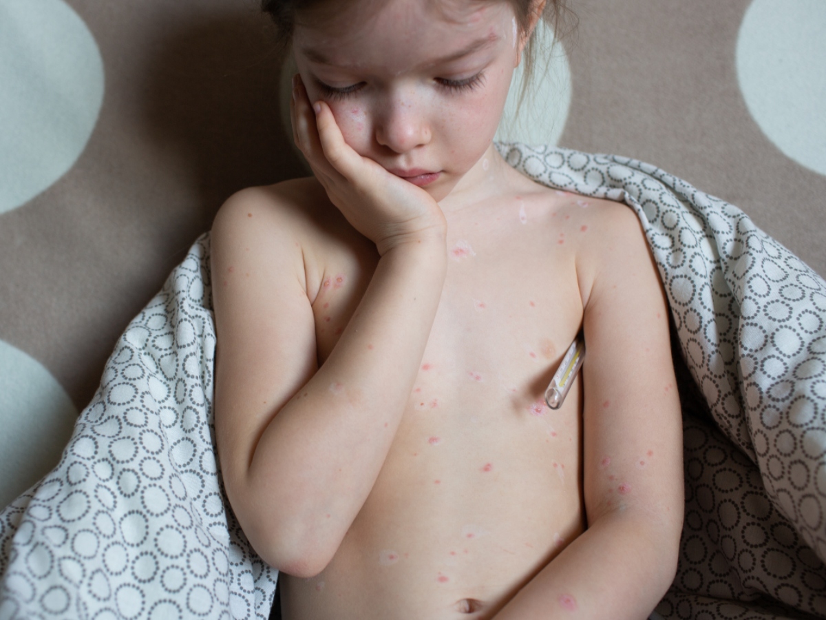 Varicella: che cos'è, contagio, sintomi, complicazioni, diagnosi, trattamenti e prevenzione 2 varicella. dati nel mondo e in Italia