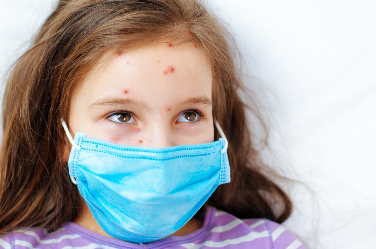 Varicella: che cos'è, contagio, sintomi, complicazioni, diagnosi, trattamenti e prevenzione 1 varicella: epidemiologia