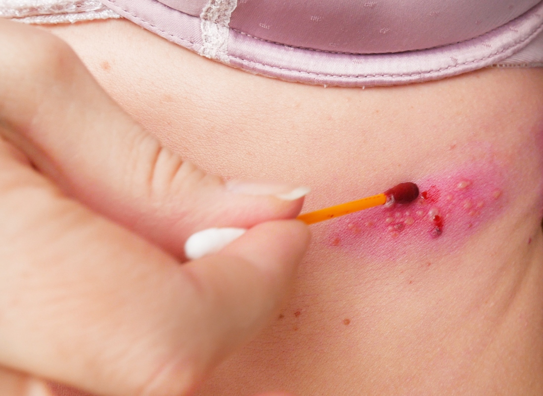 Varicella: che cos'è, contagio, sintomi, complicazioni, diagnosi, trattamenti e prevenzione 6 varicella e herpes zooster