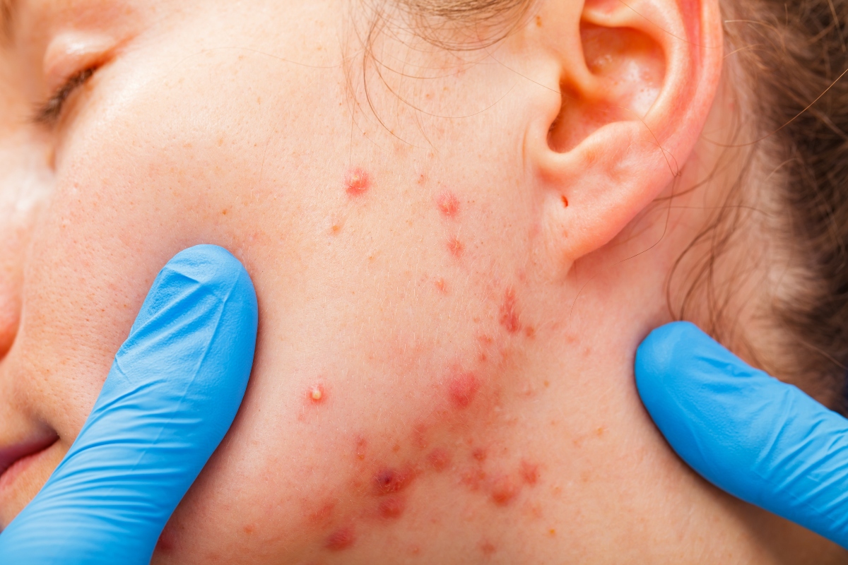 Varicella: che cos'è, contagio, sintomi, complicazioni, diagnosi, trattamenti e prevenzione 9 varicella: prognosi e decorso