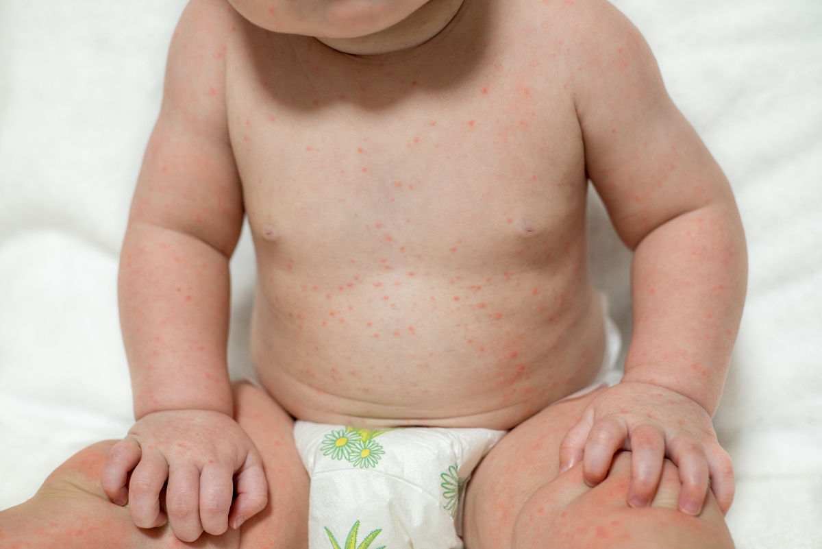 Varicella: che cos'è, contagio, sintomi, complicazioni, diagnosi, trattamenti e prevenzione 5 varicella: sintomi