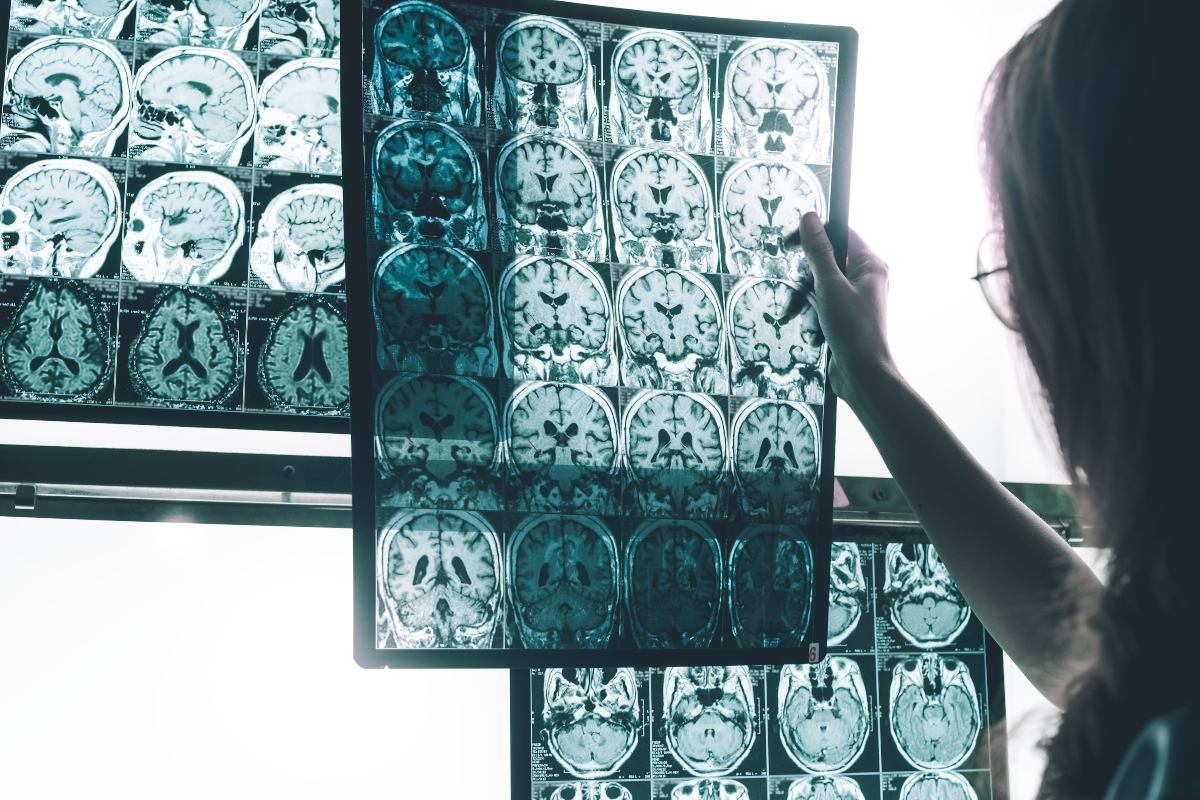 Alzheimer: che cos'è, cause e fattori di rischio, sintomi, diagnosi, cura e prevenzione 6 alzheimer diagnosi 1