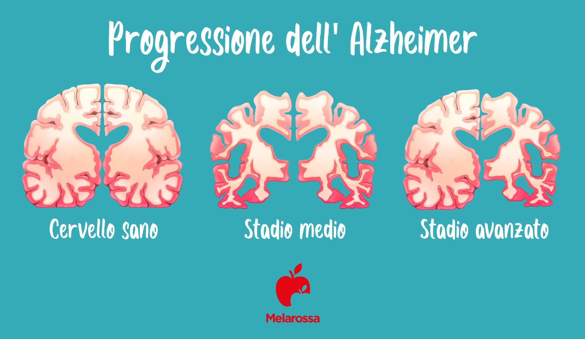 Alzheimer: che cos'è, cause e fattori di rischio, sintomi, diagnosi, cura e prevenzione 4 Progressione della malattia di Alzheimer