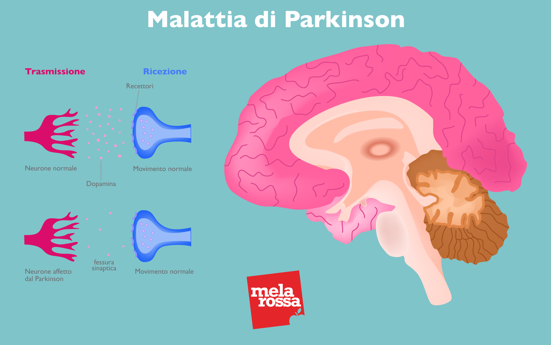 Parkinson: cos'è, epidemiologia, cause, tipi, sintomi, cura e prevenzione 1 malattia di parkison: cervello