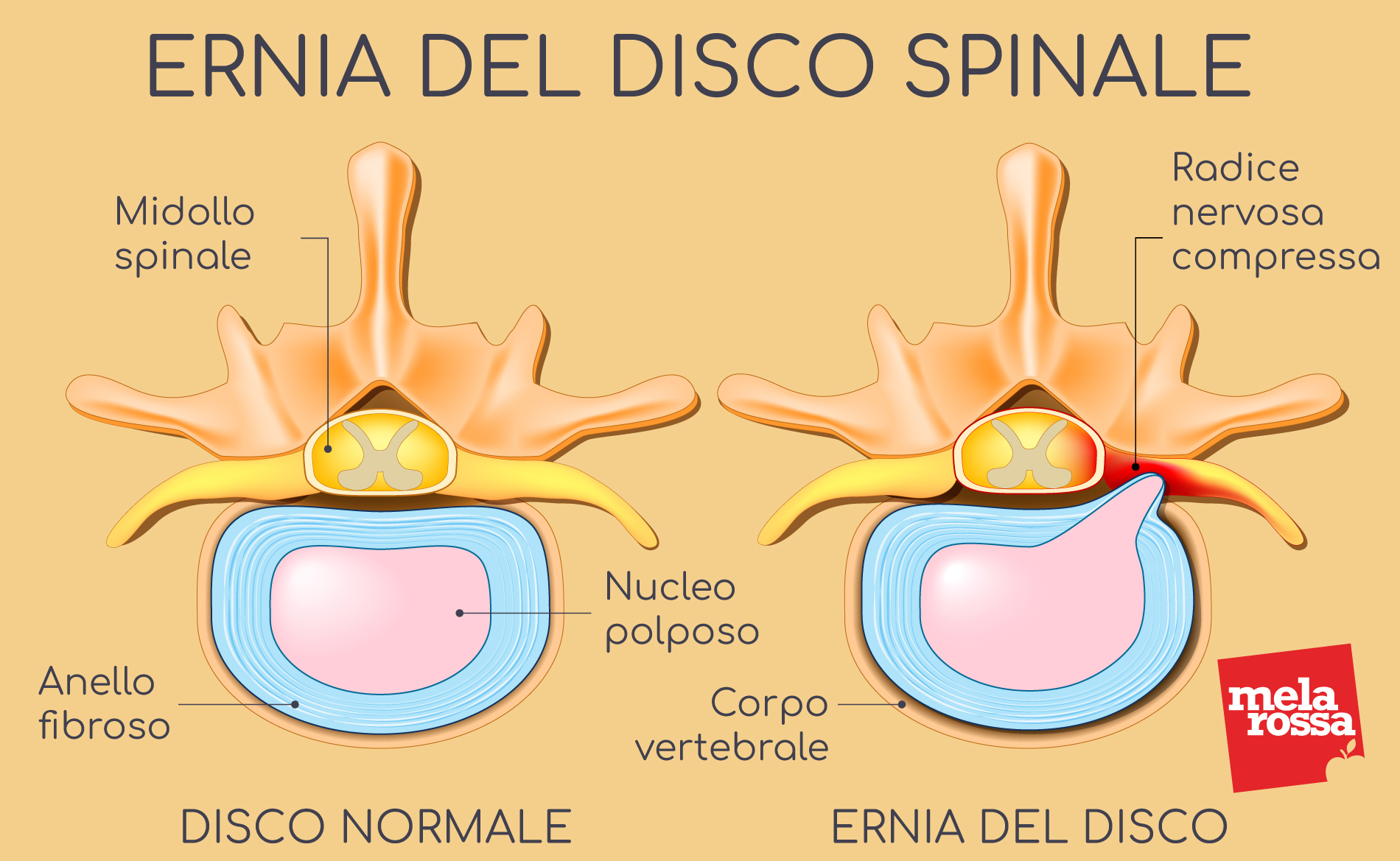 Ernia del disco: che cos'è, cause, tipi, sintomi, diagnosi e prevenzione 1 ernia del disco: che cos'è