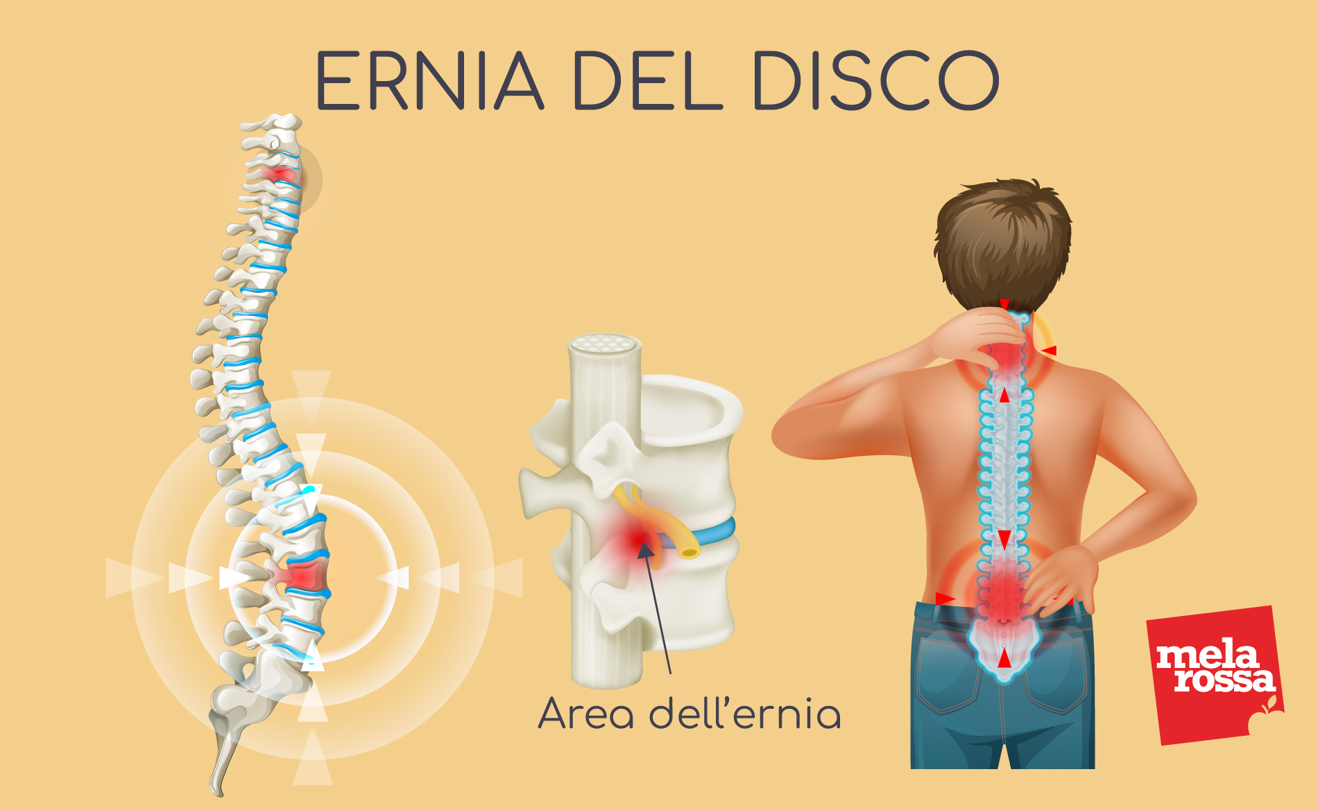 Ernia del disco: che cos'è, cause, tipi, sintomi, diagnosi e prevenzione 4 ernia del disco