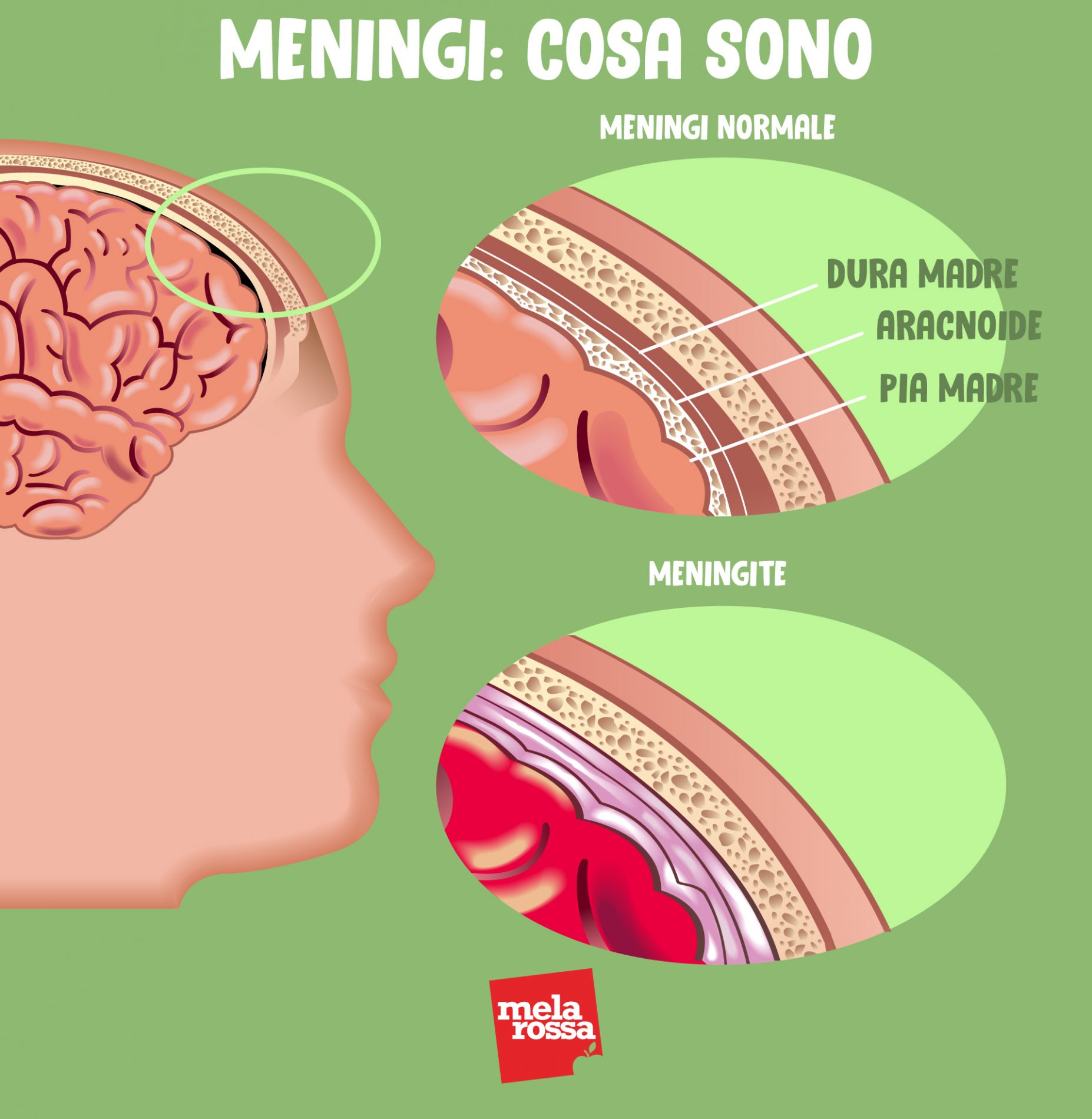 Meningite: cos'è, epidemiologia, cause, contagio, sintomi, trattamenti, decorso e prevenzione 4 meningi e meningite