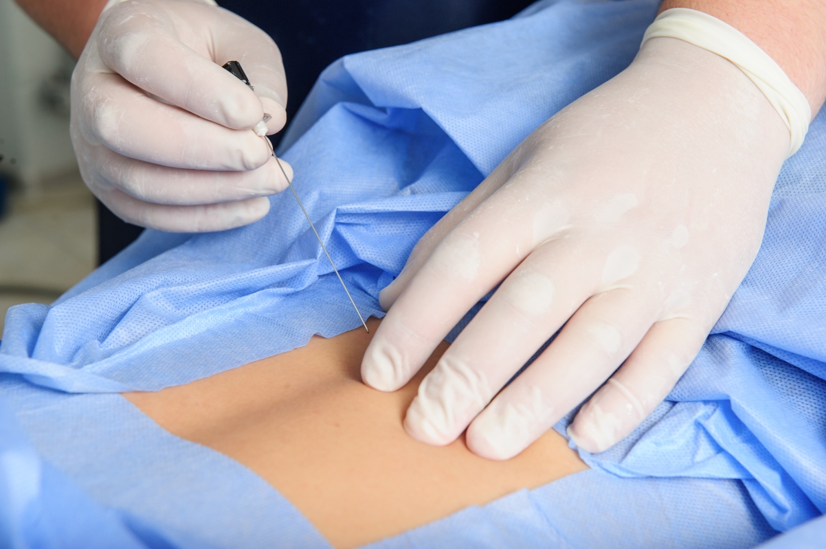 Meningite: cos'è, epidemiologia, cause, contagio, sintomi, trattamenti, decorso e prevenzione 11 meningite: puntura lombare