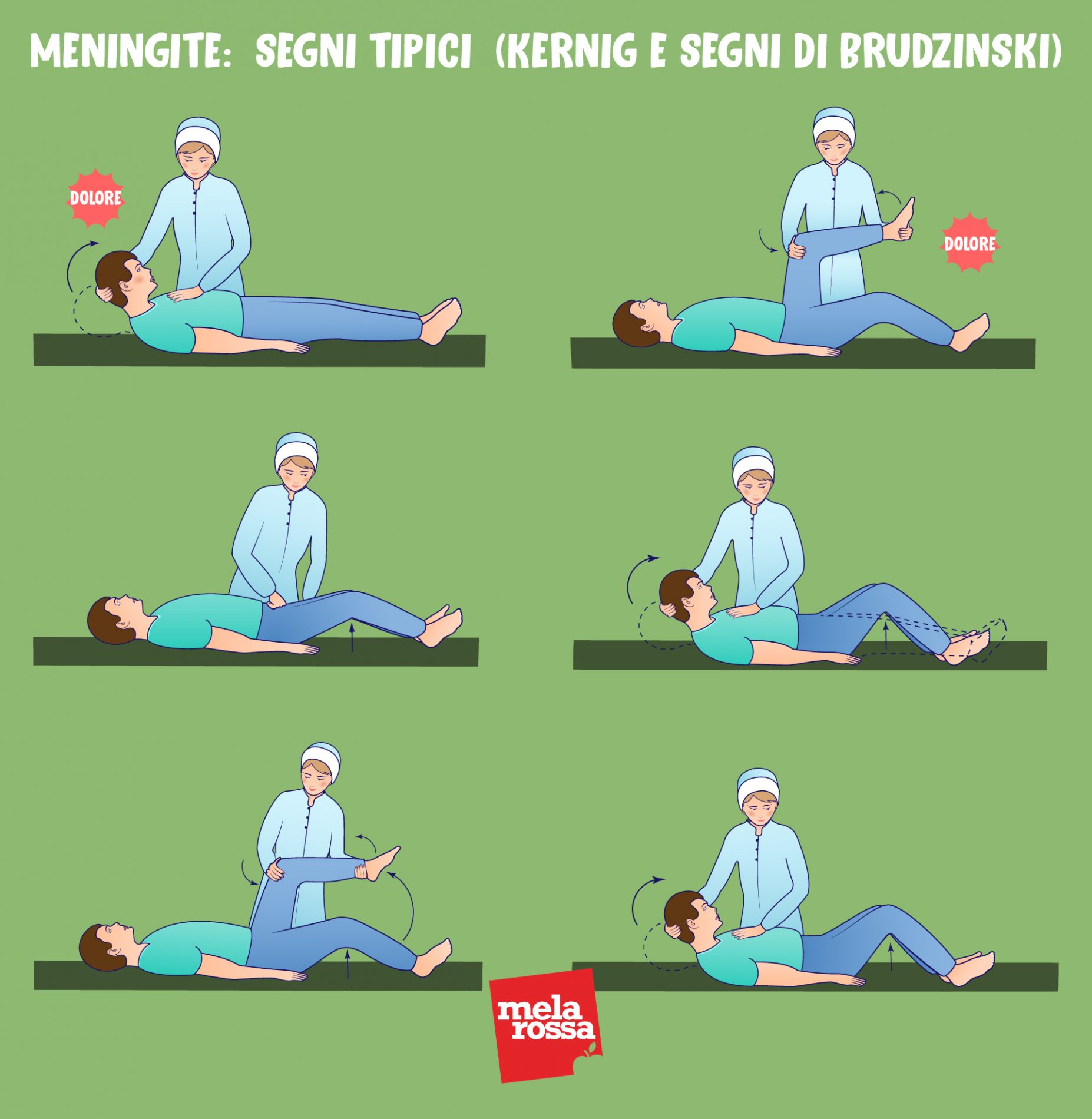 Meningite: cos'è, epidemiologia, cause, contagio, sintomi, trattamenti, decorso e prevenzione 9 meningite: segni tipici della malattia