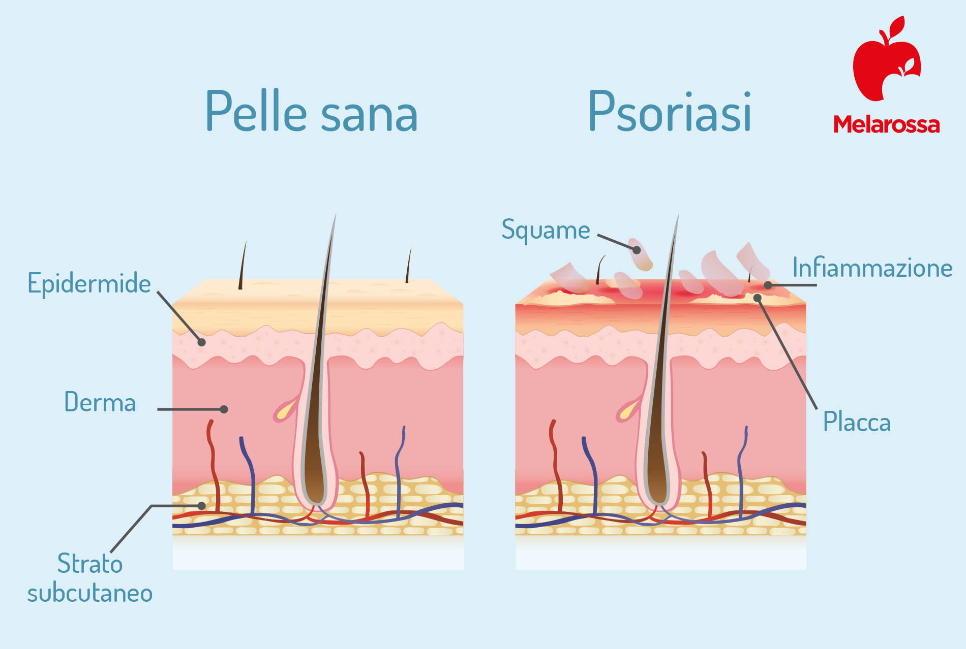 Psoriasi: cos'è, sintomi, tipi, diagnosi, cause e cure 4 Psoriasi: pelle sana e pelle malata