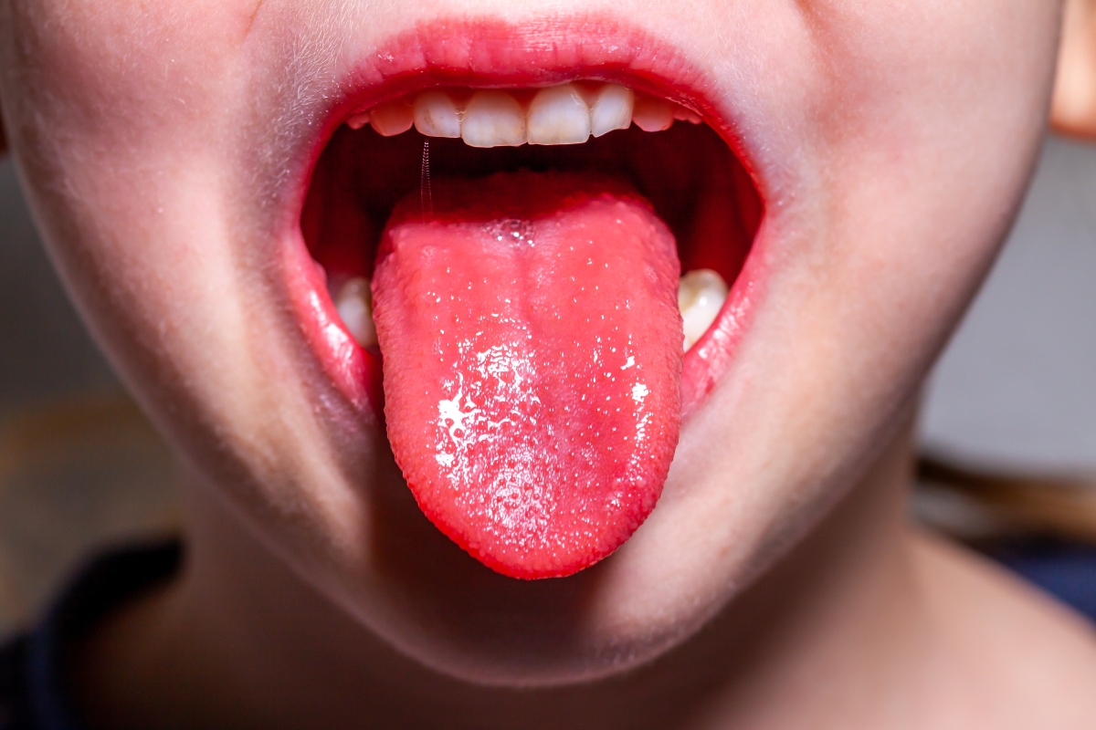 Scarlattina: che cos'è, cause, sintomi, contagio, diagnosi e trattamenti 4 scarlatina nei bambini