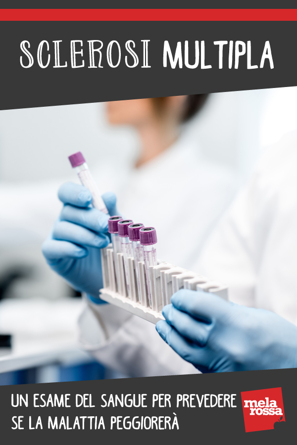 Sclerosi multipla: un esame del sangue può aiutare a prevedere se la malattia peggiorerà 1 sclerosi multipla esame prevede peggioramento