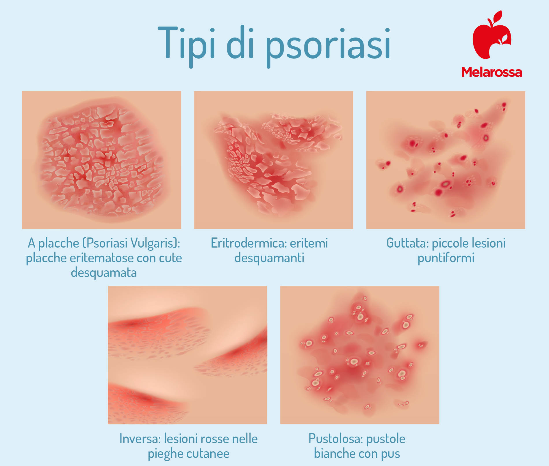 Psoriasi: cos'è, sintomi, tipi, diagnosi, cause e cure 1 Tipi di psoriasi