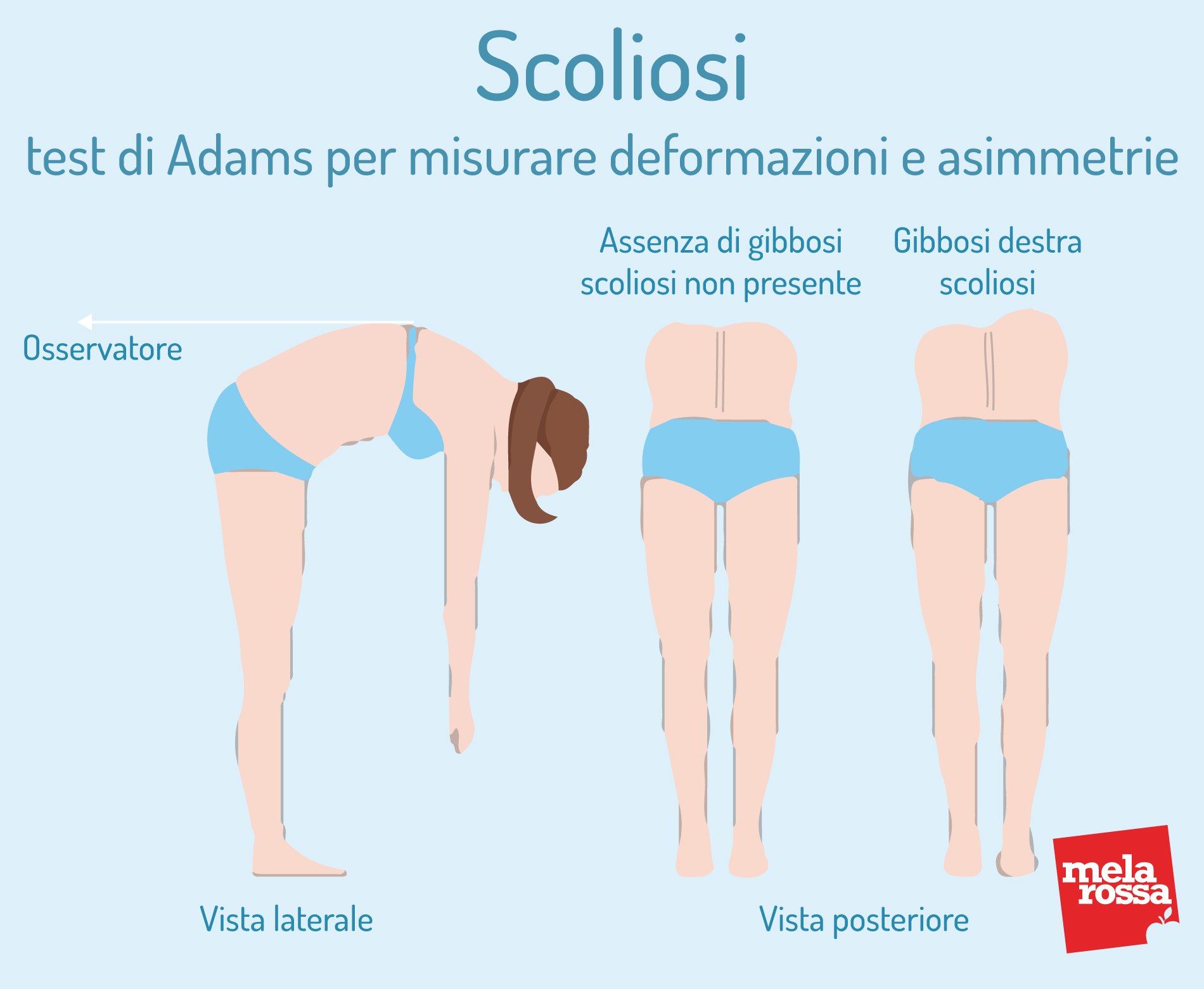 Scoliosi: cos'è, classificazioni, cause, sintomi e cura 8 Scoliosi: test di Adams per misurare deformzioni