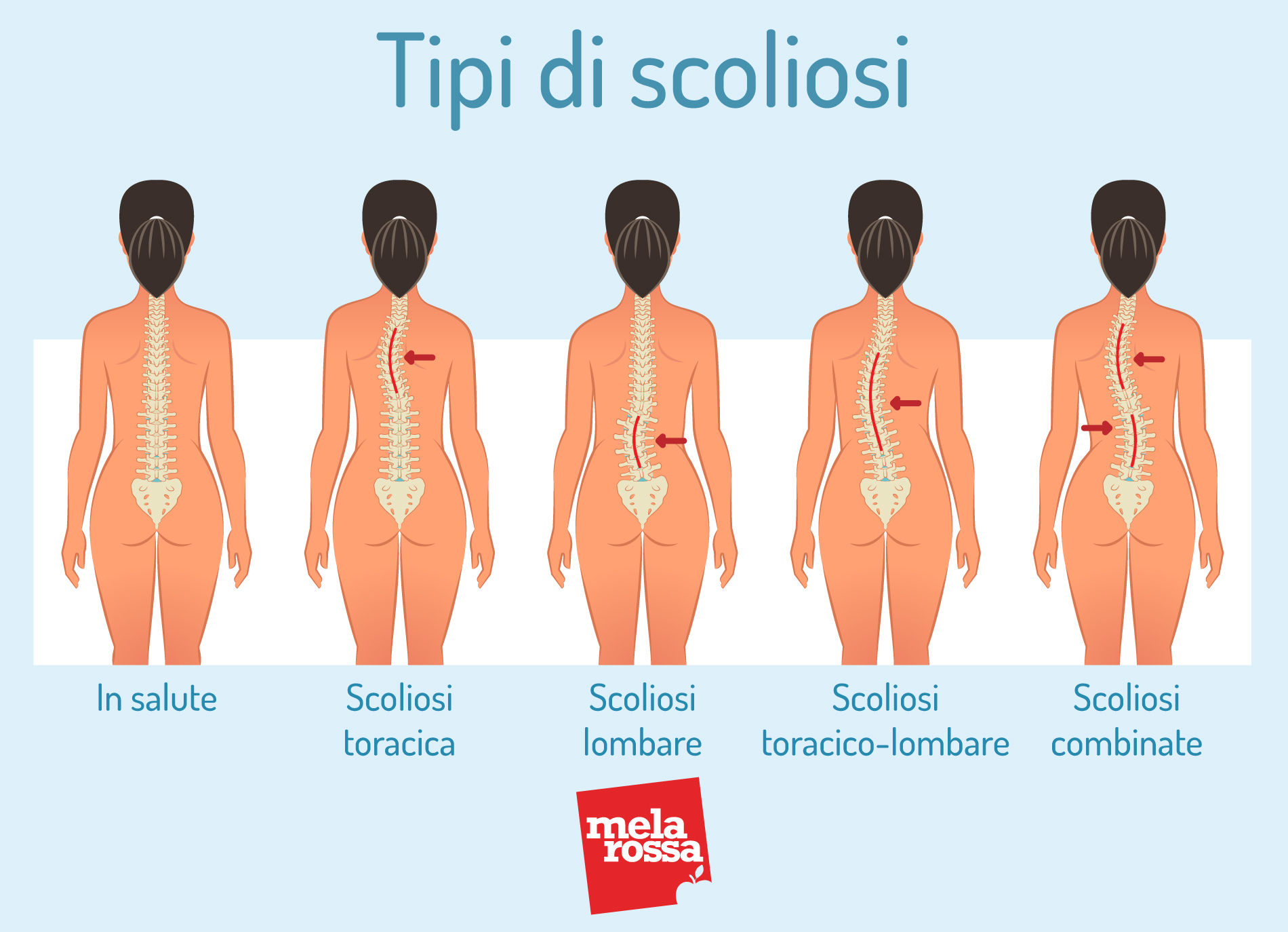 Scoliosi: cos'è, classificazioni, cause, sintomi e cura 5 Tipi di scoliosi
